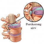 porckorong sérv