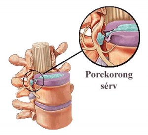 porckorong sérv